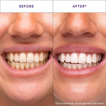 Teeth Whitening Strips